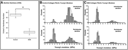 Figure 5 Graphical presentation of the nanoscale phenotypic properties (mechanical) for control and OIDI dentin (A) boxplots of the Vickers hardness value (*significance p<0.05). (B and C) Fitted histograms of the collagen fibril Young’s modulus with bimodal distributions (Gaussian R2>0.9 for all distributions) as a function of measurement site: intratubular and peritubular, respectively.