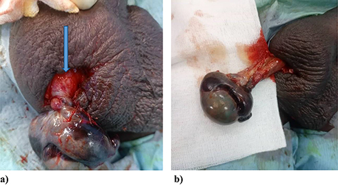 Figure 1 Twisted testis after scrototomy with turns, indicated by blue arrow (a). Unsatisfactory recolouring after spermatic cord detorsion (b).