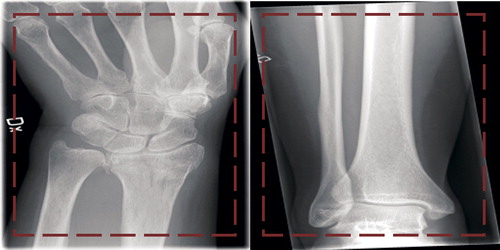 Figure 1. 2 images from the dataset. The area within the red box is the section presented to the network in order to classify the image. The left image is of a wrist fracture while the right image is without any apparent fracture.