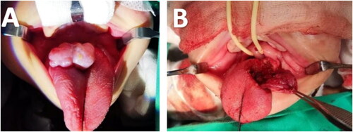 Figure 4. Significant reduction in tumour size post-chemotherapy; surgical excision of the tongue tumour (A) prior to surgical removal of the tumor, (B) post-tumour removal.