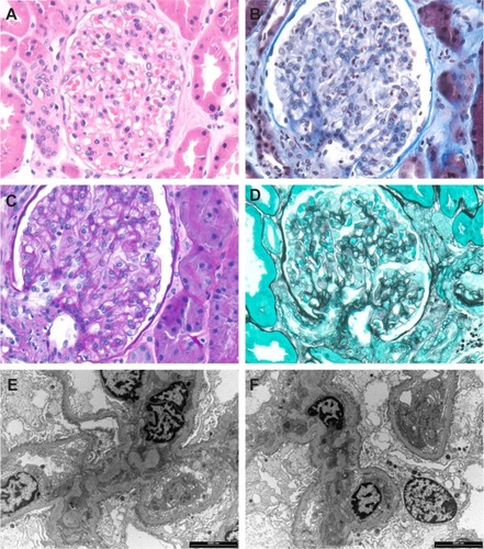 Figure 1 Class I lupus nephritis. Mesangium and capillary loops appear normal in hematoxylin and eosin-stained section (A), Masson’s trichrome (B), periodic acid-Schiff (C) and methenamine silver (D). Transmission electron microscopy also shows no abnormality in the capillary loops (E) or mesangium (F).