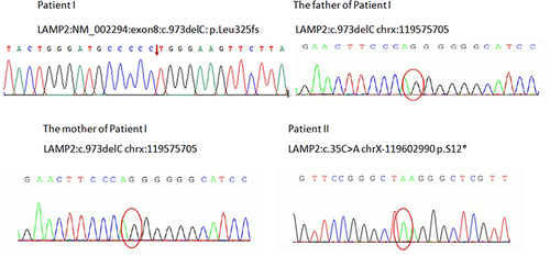 Figure 4 Patient I: LAMP2:NM_002294:exon8:c.973delC: p.Leu325fs (The red arrow represents the patient’s genetic mutation site). The father of Patient I: LAMP2:c.973delC chrx:119575705 (The red circle represents the site without genetic mutations). The mother of Patient I: LAMP2:c.973delC chrx:119575705 (The red circle represents the site without genetic mutations). Patient II: LAMP2:c.35C>A chrX-119602990 p.S12* (The red circle represents the patient’s genetic mutation site).