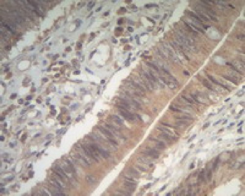 Figure 3 Positive expression of Piwil1 in colonic adenoma, ×400.