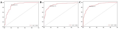 Figure 2. (A) The ROC curve of MCV<80fl influenced by MIC. (B) The ROC curve of MCV˃100fl influenced by MAC. (C) ROC curve of anisocytosis, the cut off value is 15.0%, AUC is 0.888, the sensitivity is 81.86%, and the specificity is 82.52%.