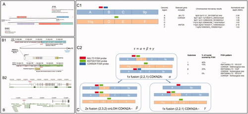 Figure 2. Schematic representation of genomic events involving KMT2A, MLLT3, CDKN2A, and ETV6::RUNX1 as identified by whole genome sequencing (WGS). (A) Representation of the ETV6::RUNX1 fusion [Citation10]. (B1) Representation of the nonproductive KMT2A rearrangement resulting from an insertion of KMT2A (from intron 1) 470 kb upstream of MLLT3 and leading to the ‘false-positive’ fluorescence in situ hybridization (FISH) fusion signal. (B2) Genomic location of breakpoints on chromosomes 9 and 11. (C1) Illustration of normal chromosomes 9p and 11q with genomic regions labeled A through F, chromosomal microarray results and Normalized Read Depth (NRD) scores. (C2) Representation of the three likely subclonal malignant populations and the corresponding FISH signal patterns. From a clone alpha (α) with an insertion of a genomic sequence from chromosome 11 (including part of KMT2A) and a deletion involving CKDN2A on the derivative chromosome 9, two subclones (beta (β) and gamma (γ)) with homozygous loss of CDKN2A likely emerged (with copy neutral loss of heterozygosity (cnLOH) from endoreduplication of the derivative chromosome 9 in the β subclone (leading to the two apparent fusion signals by FISH) and from an additional deletion involving CDKN2A on the other chromosome 9 in the γ subclone). Schematic representations were created using ProteinPaint [Citation10].