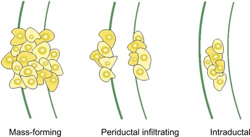 Figure 4 Morphologic classification of CCA.