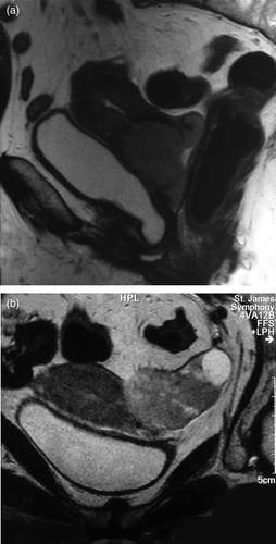 Figure 2.  A – saggital T2-weighted pelvic MRI showing a mass in the lower third of the uterus relatively hyperintense to myometrium. B – saggital oblique T2-weighted sequence demonstrating a relatively hyperintense left adnexal mass medial to the left ovary.