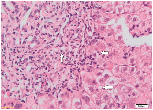 Figure 1. Patient 7’s histopathology slide showing lymphoplasmacytic infiltrates (left arrow), possible emperipolesis (top right arrow), and hepatic rosette formation (bottom arrow). Haematoxylin and eosin stain was used.
