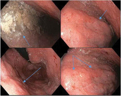Figure 3. EGD visualizing abnormal lesions in stomach demonstrating areas concerning for malignancy (arrows).