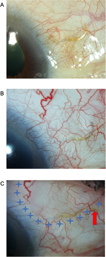 Figure 7 (A) January 2016: functioning but curved XEN 45 gel stent in place. IOP 18 mmHg without treatment 15 days after surgery. (B) March 2018 prior to needling. Pigment in XEN stent lumen, no effusion, IOP 21 mmHg on brinzolamide/brimonidine tartrate (Simbrinza®), bimatoprost (Lumigan®) and betaxolol (Betoptic®). The stent has migrated out of the anterior chamber and has no visible connection with aqueous humor on gonioscopy. (C) March 2018 post needling. The Xen stent lumen has been massaged through the intact conjunctiva towards the anterior chamber and the stent lumen is visible again on gonioscopy. Needling under and above the outer stent ostium has been performed straightening the stent, with no initial effect om filtration. The utmost part of the stent with pigmented embolus has thereafter been cut by needling (arrow), pigment and aqueous humor have drained to the subconjunctival space forming an ordinary filtration bleb (asterisk). IOP after one week washout of antihypertensive drugs = 12 mmHg.