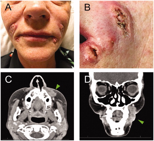 Figure 2. A. Verrucous ulcerative skin lesions on nasolabial folds, marionette lines and glabellar region (not shown). B. Detail of the lesions on the left side of the face. C and D. Arrowheads show the abnormal heterogeneous enhancing soft tissue extending along the lateral left maxilla (1.6 cm AP by 1.0 cm transverse by 2.6 cm craniocaudal dimensions).