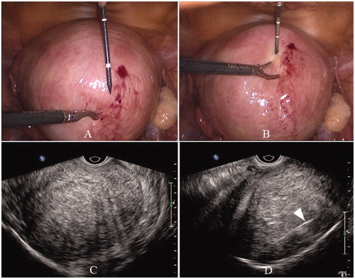 Figure 1. Laparoscope and transvaginal ultrasound images of the uterus. Laparoscope image before (A) and after (B) needle antenna puncturing into the uterus. Transvaginal ultrasound image before (C) and after (D) needle antenna (arrow) puncturing into the uterus.