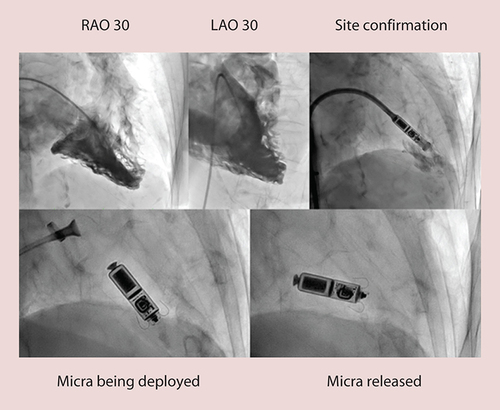 Figure 1. Micra Transcatheter Pacing System implant procedure.
