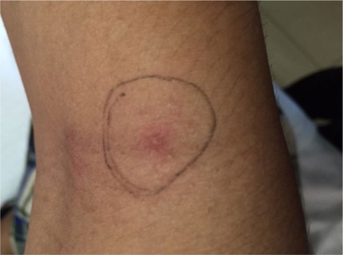 Figure 4 Positive pathergy test showed pustular lesion following 24–48 hours of 23-gauge sterile needle injected subcutaneously.