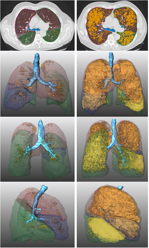 Figure 2 2D and 3D illustration of QCT analysis using MeVis PULMO3D: Image reconstructions of a 61-year-old patient without COPD (left column) and a 67-year-old patient with COPD GOLD 4 (right column) are compared. Highlighted in orange and yellow are all lung voxels with a CT density below −950 HU. The percentage of these emphysematous voxels out of all pulmonary voxels is the so-called emphysema score (TES) and was calculated to be 4% on the left and 48% on the right at maximal inspiration.