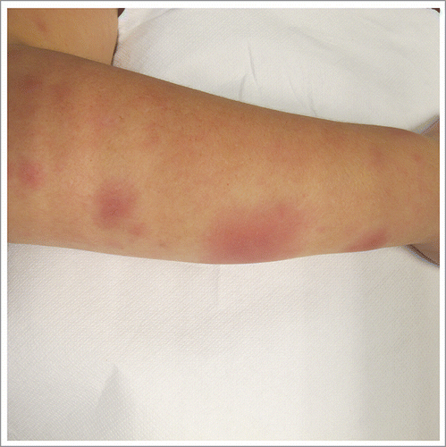 Figure 1. Erythema nodosum with bilateral eruption of painful subcutaneous nodules with overlying inflammatory redness. Involvement of only the upper extremities is unusual.