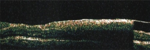 Figure 4 Vertical scan showing the level of hemorrhage to be in the subinternal limiting membrane by optical coherence tomography in patient shown in Figure 3.