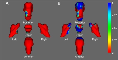 Figure 1 (A) Statistical maps corrected for age, education, and sex showing brain stem shape deformation associated with NPI sleep-disturbance subscale scores in patients with AD. (B) Group-comparison results of brain stem shape deformation between the AD group and the normal controls. Color coding of the surface reflects the FDR-corrected F-statistic values.