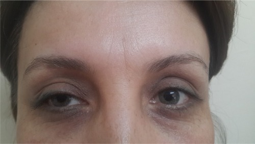 Figure 2 Ptosis after botulinum toxin injection in the right eye.