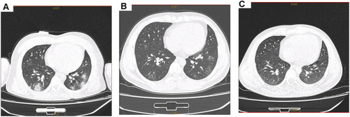 Figure 1 Chest computed tomography scan results of the 18-year-old male patient’s lung. (A) On January 23, 2020, a computed tomography (CT) scan of the patient showed patchy ground glass density shadows distributed in both lungs and bilateral pleura; (B) Chest CT examination on February 10, 2020 showed that the lung lesions were obviously absorbed; (C) CT scan images on February 28, 2020 revealed normal lungs.