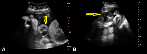 Figure 1 Two-dimensional sonographic examination showed (A) heart and liver extruded through the lower chest and upper abdomen (yellow arrow). (B) Omphalocele containing liver, intestine, and dilated bowel loops (yellow arrow).