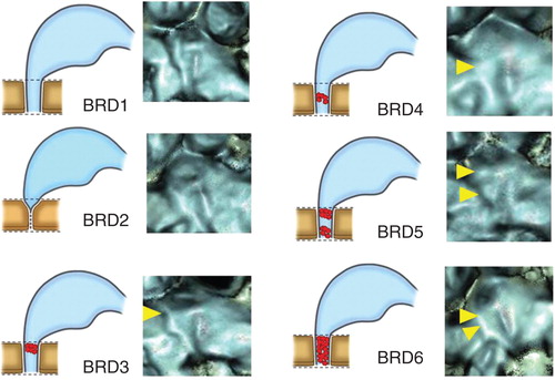 Figure 3. Occlusion patterns of bony grooves of reuniting duct (BRD). BRD1, patent throughout the entire length; BRD2, acute angle showing V-like character; BRD3, occluded at the orifice; BRD4, occluded at the middle portion of the groove; BRD5, occluded at the orifice and middle portion of the groove; BRD 6, totally occluded. Yellow arrowheads show the occluded points.
