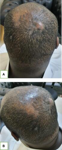 Figure 1 The patient with fluctuant, tender nodules with overlying alopecia. (A and B) Posterior and lateral views to show enlarged nodules in the scalp.