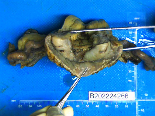 Figure 1 Grossly, the uterine presented a spongy appearance with and necrosis and ulceration.