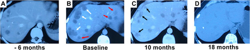 Figure 1 The complete response to interferon-alpha 2b (IFN-a 2b) is illustrated in a female patient who had progressive disease after treatment with transarterial embolization (TAE). (A) Contrast-enhanced computed tomography (CT) scan reveals multiple intrahepatic lesions. (B) After TAE, intrahepatic tumors progressed (marked with white arrows), and new lesions occurred (marked with red arrows). Then, IFN-a 2b treatment started. (C) Ten months after initiation of IFN-a 2b treatment, the size of tumors had decreased significantly (marked with black arrows). (D) Eighteen months after initiation of IFN-a 2b treatment, the intrahepatic tumors disappeared.