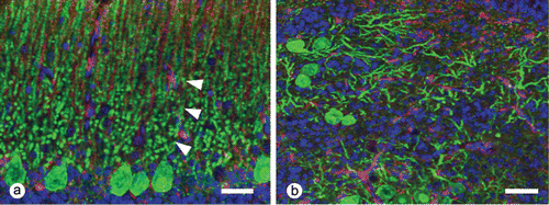 Figure 2. Immunofluorescence and confocal microscopy. 2a: Vimentin-positive Bergmann's glia (red) and calbindin D28-positive dendrites of Purkinje cells (green; arrowheads) grow straight towards the meninges in normal cortex. Immunofluorescence. Bar = 20 µm. 2b: Radiated dendrites of Purkinje cells (green) with few Bergmann's glia fibres (red) in the heterotopic cortex. Immunofluorescence. Bar = 30 µm.