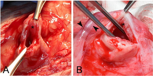 Figure 7. Gross assessment of vesicle viability of C2 (A) and C1 (B) neoreservoirs; hemorrhage noted from all layers; asterisk over mucosa; dilated ureter just proximal to insertion marked by arrowheads.