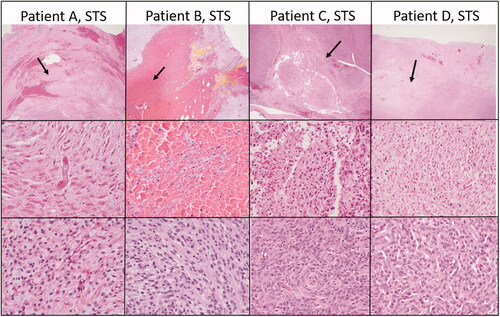 Figure 4. Select representative histopathology of patient tumors. This Figure illustrates the treated tumor at low magnification (top row), and high magnification (middle row) of four selected patients with soft tissue sarcomas that were treated with HIFU. Though treatment areas were somewhat variable, the most consistent finding is a relatively discrete focus of tumor necrosis (arrows) with hemorrhage at low magnification. In some patients (Patient B), hemorrhage and individualization of tumor cells were the most prominent feature. At higher magnification (middle row), necrotic cells exhibit coagulative necrosis characterized by individualization of cells, angular cell borders, increased ‘pinkness’ of the cytoplasm (hypereosinophilia), and dark nuclei or decrease in nuclear visibility. The bottom row illustrates what intact tumor cells look like for that patient in untreated areas of the tumor. Images taken at 2x (top row) or 40x (middle and bottom rows), H&E.