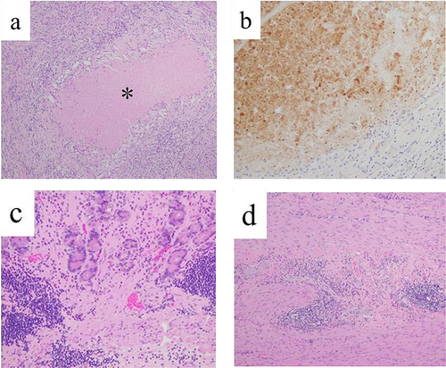 Figure 5 Histopathological findings of Virchow’s lymph nodes and primary gastric cancer by the resected specimen. (a) On hematoxylin and eosin staining of the resected Virchow’s lymph nodes, there is coagulation necrosis (*) surrounded with histiocyte. There are no viable cancer cells. (b) On immunohistochemical staining for cytokeratin (clone AE1/AE3) of the resected Virchow’s lymph nodes, the necrotic regions were stained, indicate of necrotic change of cancer cells. (c, d) On hematoxylin and eosin staining of the resected stomach, mucosa (c) and muscularis propria (d) failed to show any viable cancer cell.
