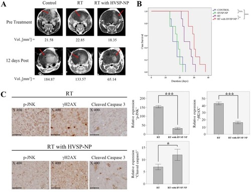 Figure 4 Survival studies for mice receiving various treatments. (A) MRI follow-up images. Tumor volume was measured using Leksell GammaPlan® (LGP, Dedicated treatment planning tool specifically designed for stereotactic radiosurgery). Red arrows indicate the presence of tumors. (B) Kaplan-Meier survival curves. (C) Immunohistochemistry staining results for p-JNK, γH2AX, and Cleaved Caspase-3 in extracted mouse brain tumors. Each immunoreactivity pattern was confirmed by quadruplicate specimens from the same mouse. Scale bar, 10 μm. Histograms showing the quantitative analysis of p-JNK, γH2AX and Cleaved Caspase3 expression levels for RT ± HVSP-NP. Error bars indicate ±SD; columns, mean.Notes: *P<0.05; ***P<0.001.Abbreviation: n.s., not significant by Log rank test.