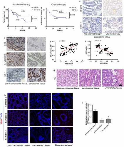 Figure 1. The expression of IRF6, E-cadherin and Ki67 in CRC tissues and relation of IRF6 and survival of CRC patients, E-cadherin as well as Ki67 expression. (a) Survival curves of CRC patients with IRF6 low expression or no expression (IRF6(-)) and high IRF6 expression (IRF6(+)) as well as without chemotherapy. (b) Survival curves of CRC patients with IRF6 low expression or no expression (IRF6(-)) and high IRF6 expression (IRF6(+)) as well as with chemotherapy after surgery. (c) Tunel staining to analyze cell apoptosis in CRC tissues without chemotherapy or with chemotherapy prior to surgery. (d) Immunohistochemical staining to analyze IRF6, E-cadherin and Ki67 expression in para-carcinoma tissue and carcinoma tissues of CRC patients with chemotherapy after surgery. (e) Correlation analysis of E-cadherin and IRF6 indicated by average optical density (AOD) value in CRC tissues. n = 100. (f) Correlation analysis of Ki67 and IRF6 indicated by AOD value in CRC tissues. n = 100. (g) HE staining; (h) IRF6 expression and localization were assayed using immunofluorescence staining. (i) Relative quantitative analysis for IRF6 expression. ** p < 0.01 vs para-carcinoma tissue; # p < 0.05 vs carcinoma tissue. n = 5.