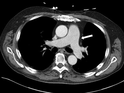 Figure 3 Computed tomographic (CT) Image of the Mediastinum. CT angiographic image of thorax in a SSc patient demonstrating a markedly dilated pulmonary artery (arrow) without thrombus consistent with pulmonary artery hypertension (PAH).