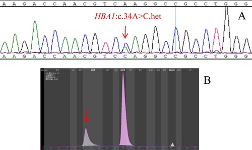 Figure 2. (A): The hemoglobin variant Hb J-Wenchang-Wuming identified by Sanger sequencing. The arrow shows the mutation of the HBA1 gene. (B): Hb J-Wenchang-Wuming eluted in Z12 on the Capillarys 2 CE analyzer. The arrow shows the abnormal peak.