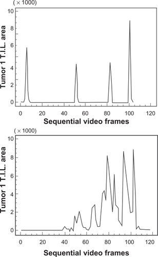 Figure 4 Two separate breast cancer tissue sections (tumor 1 and 2) immunostained using CD3 antibody, both graded as +++ by manual visual methods, but revealing different distributions of cells across the respective tissue sections (×400).