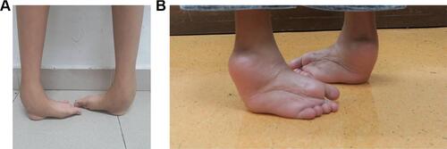 Figure 2 (A) Bilateral untreated clubfoot seen anteriorly; weightbearing on talus prominences and dorsum of the forefeet. (B) The same clubfoot seen from posterior in standing position; both feet adducted and supinated with equinus deformity.