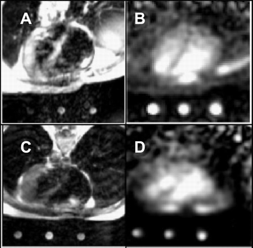 Figure 1. Registered axial 1H MRI fast spin echo images (images A and C, TR = IR‐R interval at 62 bpm, echo train length 8, effective TE 17 ms), and axial slices from a 3D 23Na TPI data set of the heart (images B and D, TR/TE = 100/0.17 ms, AHP excitation) of two healthy human volunteers. The 3D 23Na image data were interpolated so that image B and D match the spatial position of image A and C.