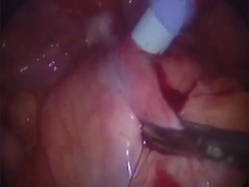 Figure 3 Placement an amplatz sheath over facial dilator into renal pelvis under laparoscopic guidance.