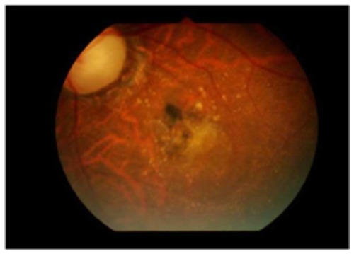 Figure 4 Partly scarred choroidal neovascular membrane.