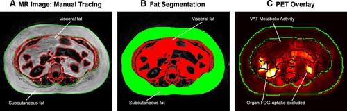 Figure 2 Adipose tissue manual tracing and segmentation. (A) Axial MR slice, with manual tracing of the outer contours of subcutaneous adipose tissue (SAT), performed for each slice from the pelvic floor to the level of the diaphragm. (B) Fat segmentation using a custom-made MATLAB script to perform automated analysis of pixel intensity to discriminate tissue class (visceral adipose tissue [VAT] in the abdomen from other organs). Adipose tissue areas from each slice were then summed across the abdomen for total SAT and VAT volumes. (C) Adipose tissue FDG uptake was measured using standardized uptake values (SUV) within the segmented VAT and SAT compartments of each analyzed slice, excluding organ (renal) FDG uptake.