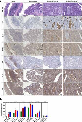 Figure 4. Intratumoral distribution of immune cells in AOM-DSS mice with and without ST11 K. pneumoniae co-administration. (a) Consecutive sections of Swiss colon rolls were subjected to H&E stain and were immunostained with specific antibodies against CD163, iNOS, Foxp3, CD3, IL-10, and IL-17. Representative images from the control or the AOM-DSS mice, which were treated alone (middle-left panel) or co-administrated with KPC160111 (middle-right panel) or KPC160132 (right panel), are presented. (b) The rates of cells with positive signals for each of the antibodies were quantified by HistoQuest Software at a high-powered field in 5 randomly selected areas in each of the tumors or corresponding control regions. Data are presented as mean ± SD (n = 30 in each group). P values were determined by two‐tailed Student’s t-test between AOM‐DSS-alone and AOM-DSS-KPC160111 or AOM-DSS-KPC160132. * P < .05