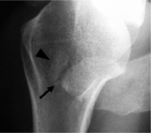 Figure 1a. Axillary radiograph of a left shoulder with an os pre-acromiale. The black arrow indicates the non-ossified gap between the os pre-acromiale and the acromion.