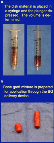 Figure 7 Volumetric measurement of disk material removed and bone graft to be delivered.