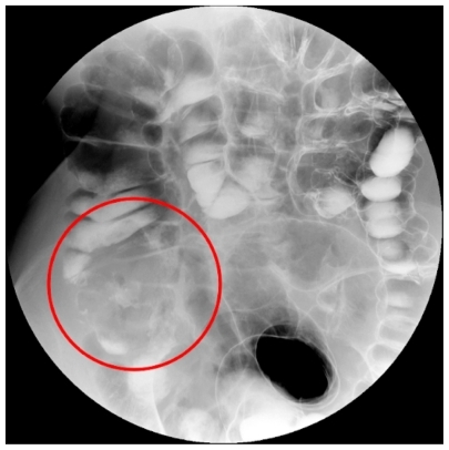 Figure 1 Large carcinoma of the cecum (red circle) as displayed on double contrast barium enema image. Lesion presence is inferred indirectly as a filling defect of the cecal lumen with irregular mucosal lining.