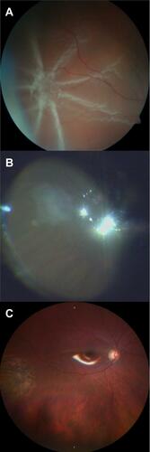 Figure 1 Pre- (A), intra- (B) and postoperative (C) fundus photography of PVR star-fold treated with cryocoagulation.