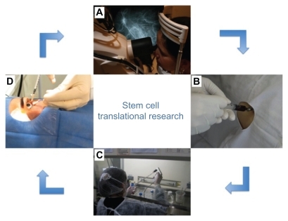 Figure 1 Scheme showing translational research conducted by our research group (Clinicaltrial.gov: NCT01068561). This clinical trial was about the use of bone marrow-derived stem cell for the treatment of retinal dystrophy. The patient is examined at the research center (A). The bone marrow is collected for bone marrow transplantation (B). The material collected is taken to the cell therapy laboratory for stem cell separation (C). Stem cells are injected into the patient’s eye in an operating room (D). The patient is again evaluated at the research center (A).