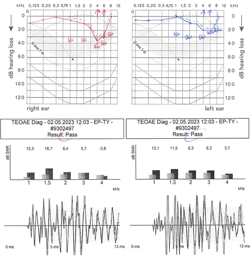 Figure 5 Sensorineural hearing loss in the right inner ear with chronic tinnitus aurium in a 53-year old professional flautist. History of 42 years of transverse flute-playing and > 60,000 cumulative practice hours (average 4h/day). Above: Pure-tone audiometry with right-sided noise induced c5-dip (ie, 4 kHz loss) caused by asymmetric long-term postural exposure to higher loudness levels of own instrument. Below: Transitory evoked otoacoustic emissions (TEOAE) with evidence of damage to the outer hair cells.